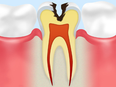 お口の中にいる虫歯菌が、食べ物の中の糖分をエサにプラーク（歯垢）を作り出し、歯の表面に付着して繁殖する。