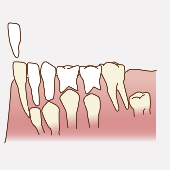 乳歯から永久歯への生え変わりで気をつけたいこと 画像01