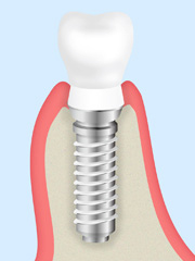 スター歯科のインプラント治療