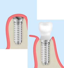 スター歯科のインプラント治療