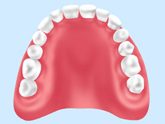 プラスチック義歯(保険診療の入れ歯)