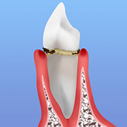歯周病初期：歯肉炎