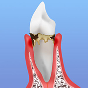 軽度歯周病：歯周炎
