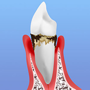 中等度歯周炎：歯槽骨の破壊