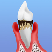 重度歯周炎：歯が抜け落ちる