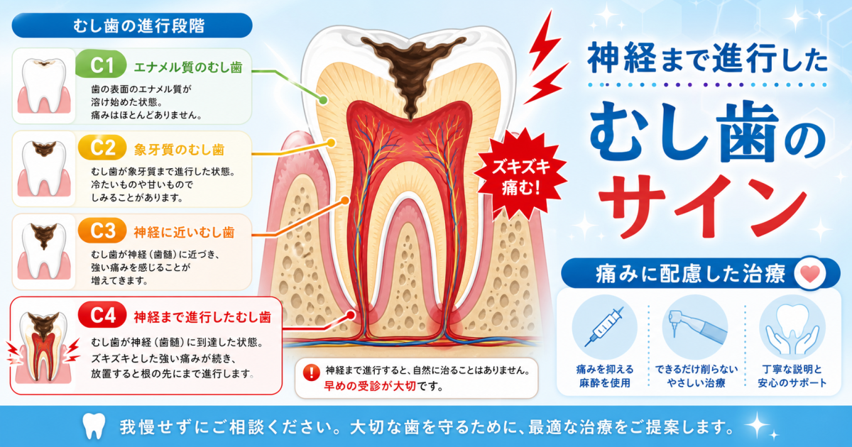 虫歯放置でズキズキ痛む!神経まで進行した症状と痛くない治療法